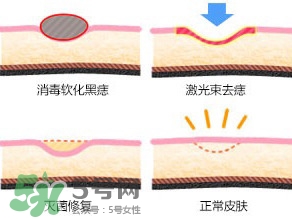 藥水點(diǎn)痣和激光點(diǎn)痣哪個(gè)好？各有什么優(yōu)缺點(diǎn)