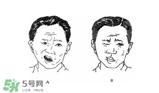 面癱是什么導(dǎo)致的？面癱多久徹底恢復(fù)正常