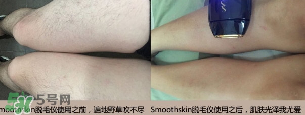 smoothskin和slikn infinity哪個(gè)好？smoothskin脫毛儀怎么樣