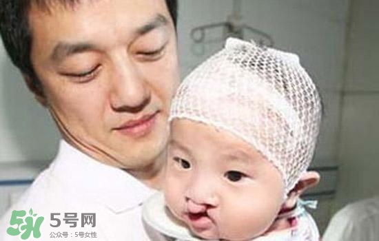兔唇是什么？兔唇是什么原因造成的？