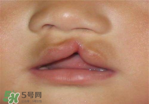 兔唇能檢查出來嗎？兔唇能完全修復嗎？