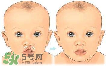 兔唇能檢查出來嗎？兔唇能完全修復嗎？