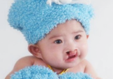 兔唇可以治嗎？兔唇修補術