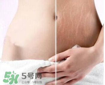 妊娠紋怎么長在大腿上了？妊娠紋會(huì)不會(huì)長在大腿上？