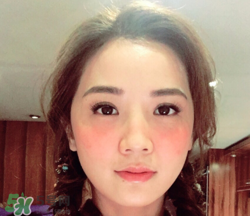 夏天可以點(diǎn)痣嗎？夏天點(diǎn)痣后要注意什么？