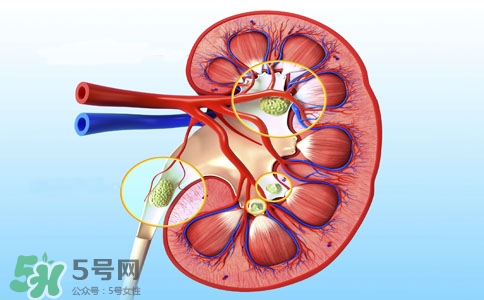 腎結(jié)石有什么癥狀？腎結(jié)石原因
