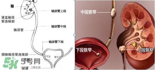 腎結(jié)石怎么治最好？腎結(jié)石的醫(yī)治方法