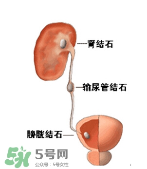 腎結(jié)石有什么癥狀？腎結(jié)石原因