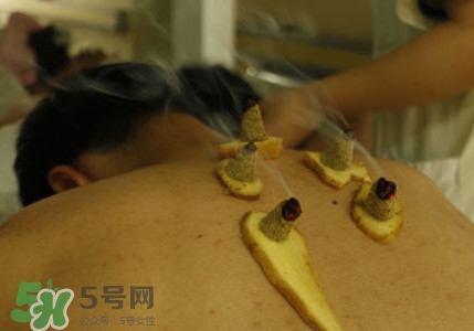 三伏灸有用嗎？2017年三伏艾灸時間