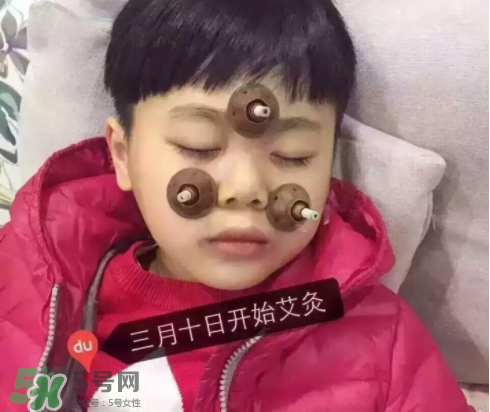 艾灸貼可以治咳嗽嗎？艾灸貼可以治退燒嗎？