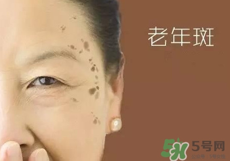 老年斑多大年齡開始有？為什么牙膏能去老年斑？