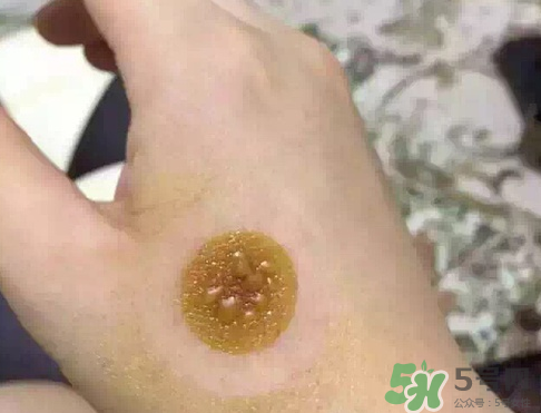 艾灸貼后有水泡怎么辦？貼艾灸貼應(yīng)注意些什么？