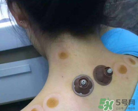 艾灸貼后有水泡怎么辦？貼艾灸貼應(yīng)注意些什么？
