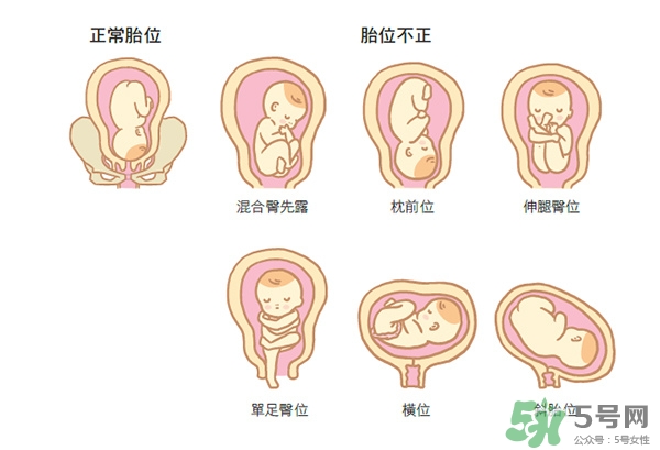 胎位不正如何矯正？胎位不正一定要剖腹產(chǎn)嗎？