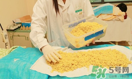隔姜灸效果怎么樣？隔姜灸好還是直接灸好