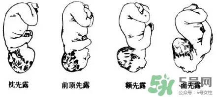 胎位不正能順產(chǎn)嗎？胎位不正怎么辦？