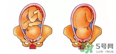 胎位不正能順產(chǎn)嗎？胎位不正怎么辦？