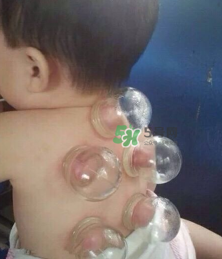 拔火罐后顏色多久消失？拔火罐印子多久能消除？