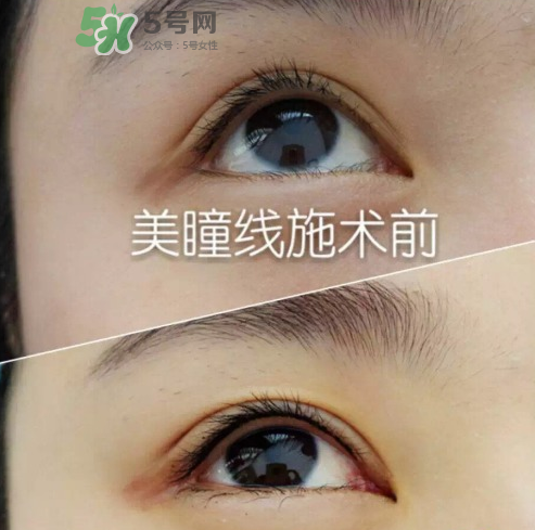 做美瞳線可以吃雞蛋嗎？做美瞳線能吃雞蛋嗎？