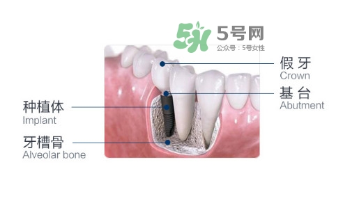 種植牙費(fèi)用多少錢？國(guó)產(chǎn)種植牙價(jià)格