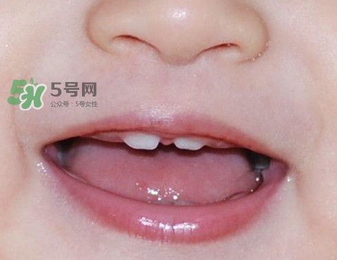 牙齒縫隙大怎么辦？牙縫大帶牙套有用嗎