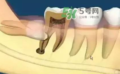 智齒是每個人都會長嗎？拔智齒能瘦臉嗎？