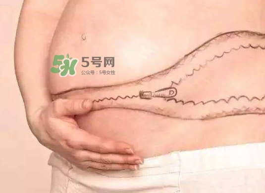 剖腹產(chǎn)疤痕怎么去除？剖腹產(chǎn)疤痕能去掉嗎？