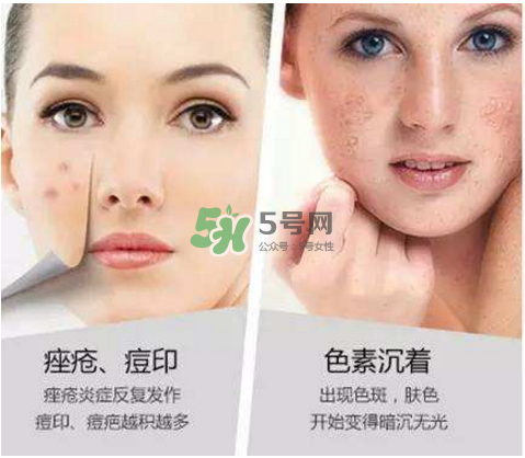 果酸換膚自己可以做嗎？果酸換膚后注意事項