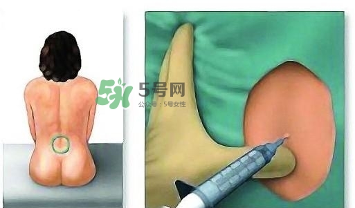 無(wú)痛分娩為什么不提倡？無(wú)痛分娩有后遺癥嗎？