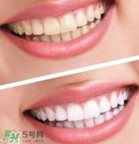 碧緹福美牙儀對牙齒有傷害嗎？碧緹福美牙儀會(huì)反彈嗎？