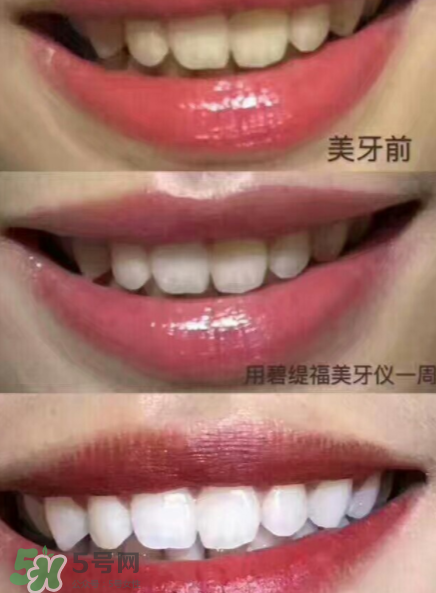 美牙儀能用水洗嗎？美牙儀能用多久？