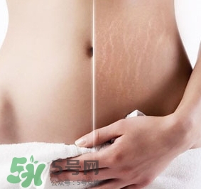 妊娠紋什么時候變白？妊娠紋產(chǎn)品什么時候用？