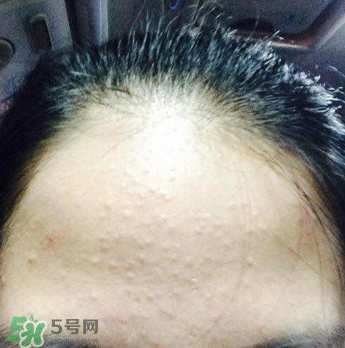 長痘長閉口怎么辦？長痘長閉口是什么原因？