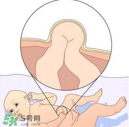 臍疝是什么？臍疝對寶寶有什么影響？