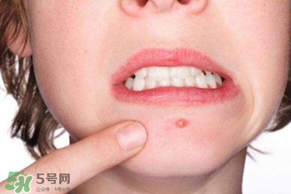暗瘡可以擠壓?jiǎn)?？油性和骯臟肌膚會(huì)容易有暗瘡嗎？