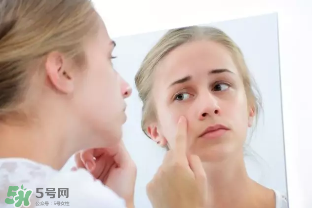 暗瘡可以擠壓?jiǎn)?？油性和骯臟肌膚會(huì)容易有暗瘡嗎？