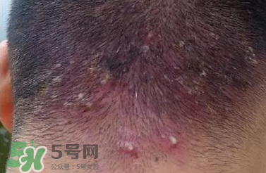 痤瘡和毛囊炎一樣嗎？痤瘡與毛囊炎區(qū)別