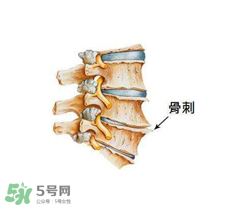 骨刺是怎么形成的？骨刺怎么治療？