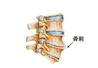 骨刺是怎么形成的？骨刺怎么治療？
