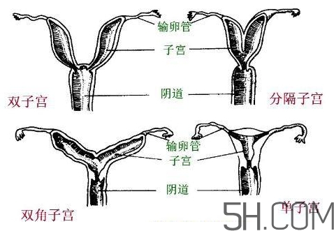 子宮畸形有哪些？子宮畸形有什么影響？