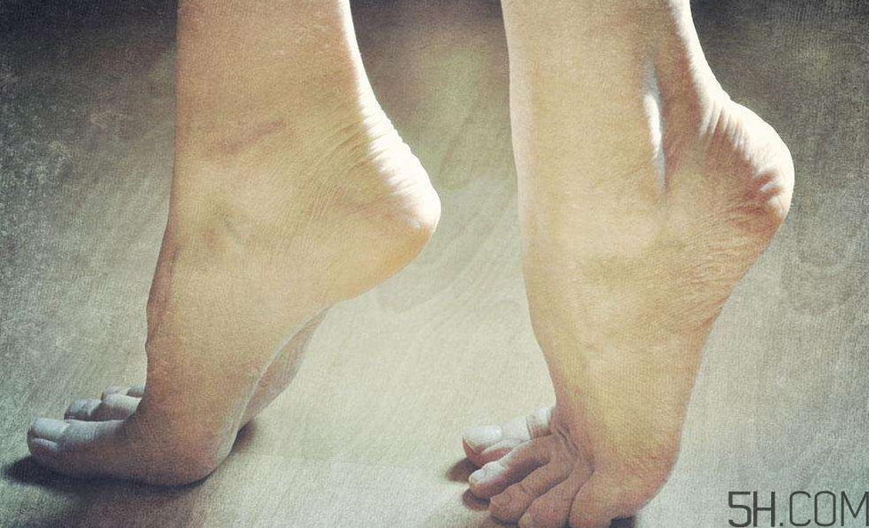 腳氣是什么原因引起的？腳氣是濕氣重引起的嗎?