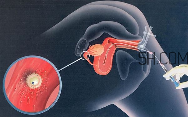 人工授精取卵子怎么取？人工授精男人怎樣取精？
