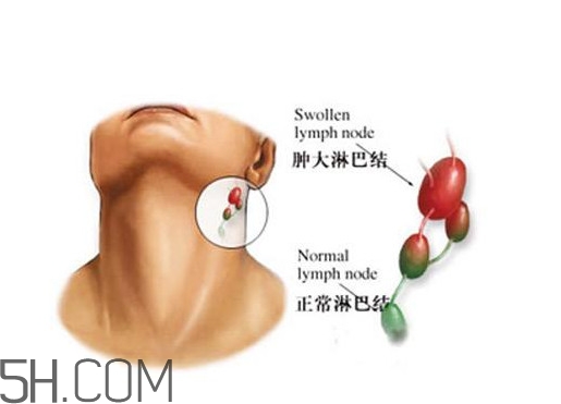 淋巴癌能活多久？淋巴癌癥狀有哪些