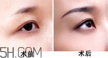 切眉手術(shù)后老得快嗎？切眉能保持多久？