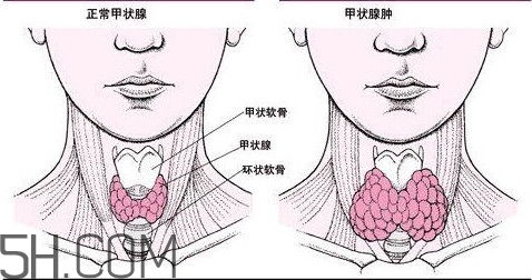 甲狀腺結(jié)節(jié)與甲狀腺腫瘤的區(qū)別有哪些？甲狀腺結(jié)節(jié)可以艾灸嗎