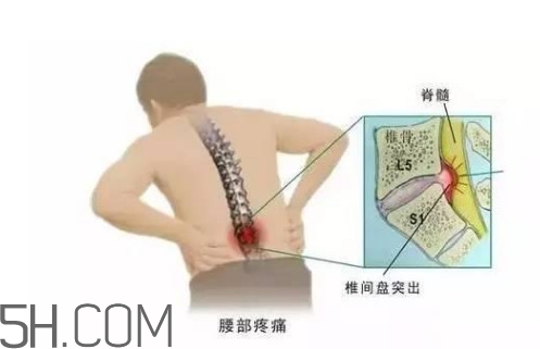 腰間盤突出是什么原因引起的？腰間盤突出是腎虛嗎