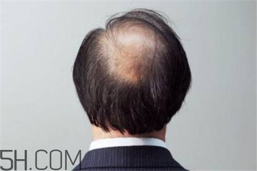 為什么男性比女性更容易脫發(fā)？什么原因?qū)е履行悦摪l(fā)？