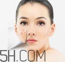 濕熱型痤瘡是什么？怎么調(diào)理濕熱型痤瘡？