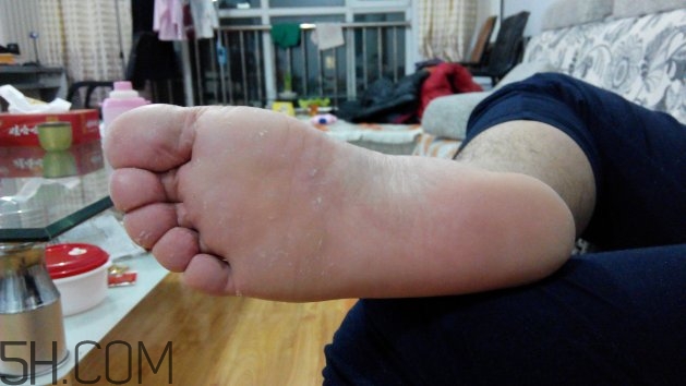 腳氣可以用酒精消毒嗎？腳氣可以用碘伏消毒嗎？
