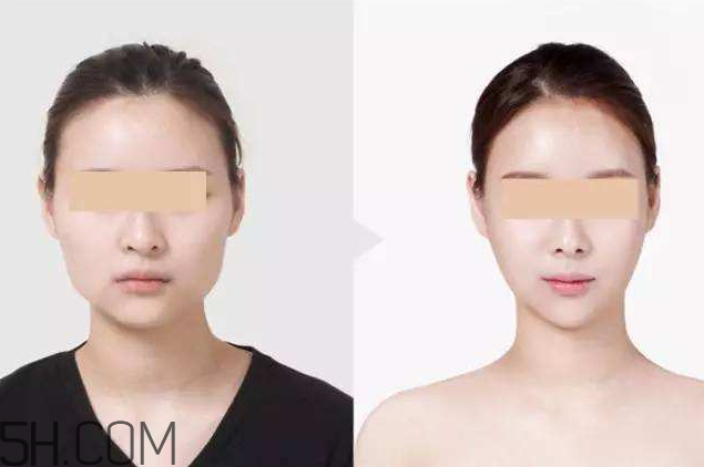 打瘦臉針可以抽煙嗎？打瘦臉針會反彈嗎？